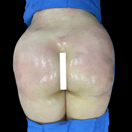 Brazilian Butt Lift Case 18 - After