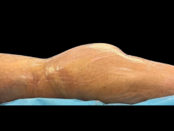 Brazilian Butt Lift Case 19 - Before