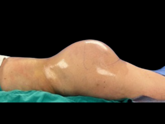 Brazilian Butt Lift Case 19 - After