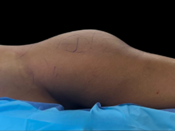 Brazilian Butt Lift Case 20 - Before