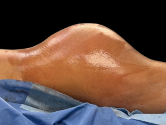 Brazilian Butt Lift Case 20 - After