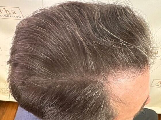 Hair Transplant Results: Case 6 - After