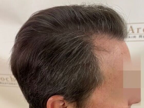 Hair Transplant Results: Case 6 - After