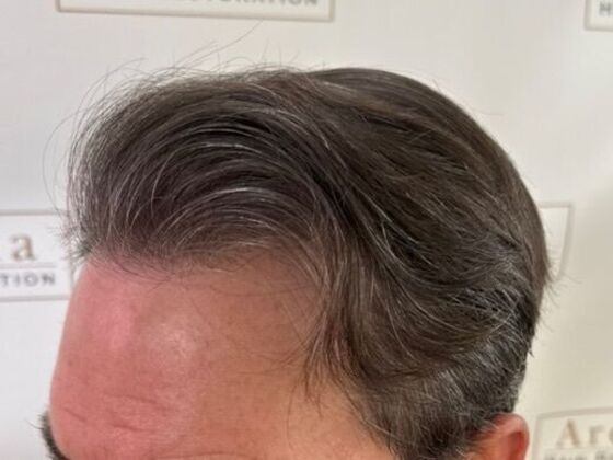 Hair Transplant Results: Case 6 - After