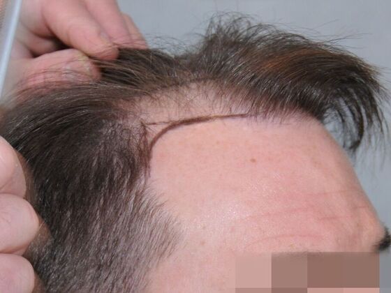 Hair Transplant Results: Case 6 - Before