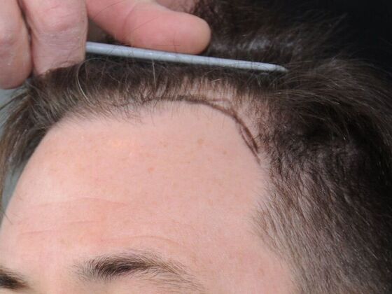 Hair Transplant Results: Case 6 - Before