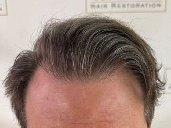 Hair Transplant Results: Case 6 - After
