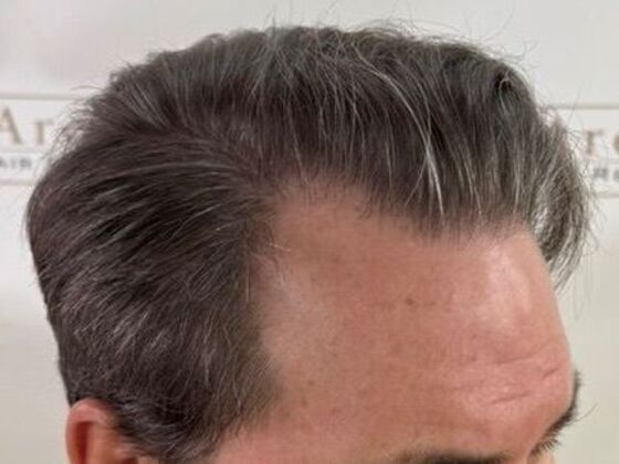 Hair Transplant Results: Case 6 - After