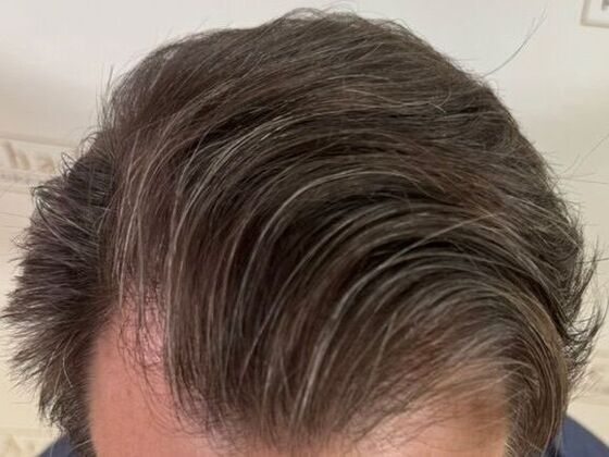 Hair Transplant Results Case 6 - After