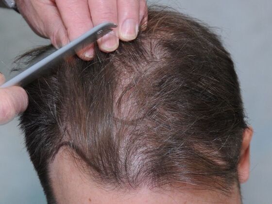 Hair Transplant Results Case 6 - Before