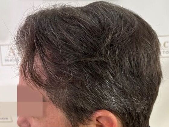 Hair Transplant Results: Case 6 - After