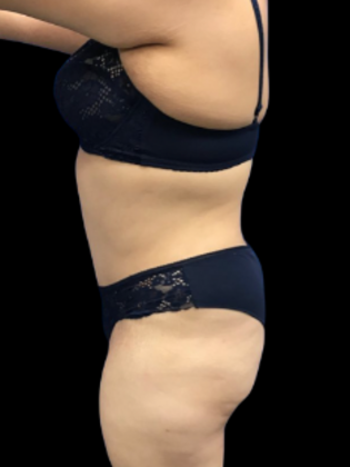 Tummy Tuck Case 9 - After