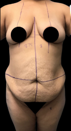 Tummy Tuck: Case 9 - Before