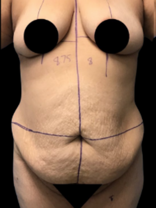 Tummy Tuck: Tummy Tuck 10 - Before