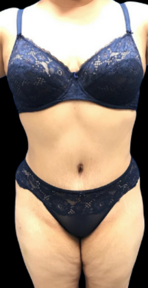 Tummy Tuck: Case 9 - After