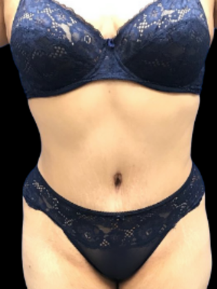 Tummy Tuck: Tummy Tuck 10 - After