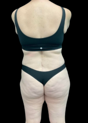Tummy Tuck: Case 10 - Before