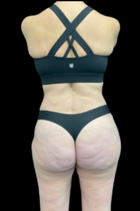 Tummy Tuck: Case 10 - After