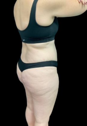 Tummy Tuck: Case 10 - Before