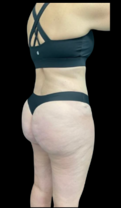 Tummy Tuck: Case 10 - After