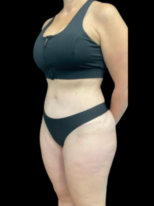 Tummy Tuck Case 10 - After