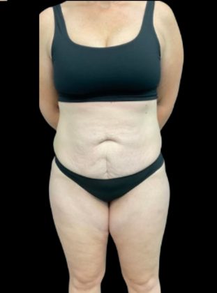 Tummy Tuck: Case 10 - Before