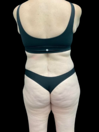 Brazilian Butt Lift Case 21 - Before