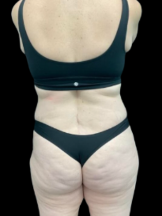 Brazilian Butt Lift BBL 16 - Before