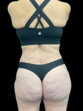 Brazilian Butt Lift Case 21 - After