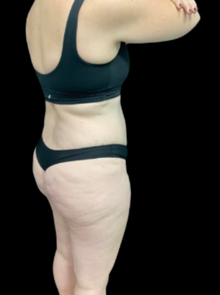 Brazilian Butt Lift: Case 21 - Before