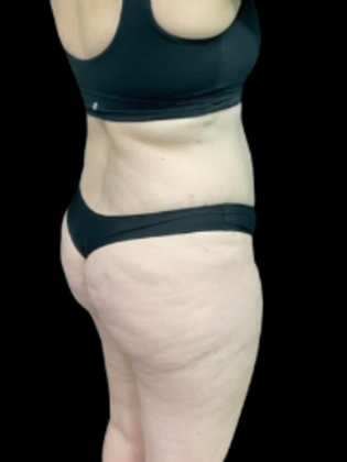 Brazilian Butt Lift: BBL 16 - Before