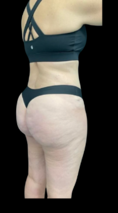 Brazilian Butt Lift: Case 21 - After