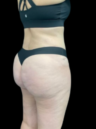 Brazilian Butt Lift: BBL 16 - After