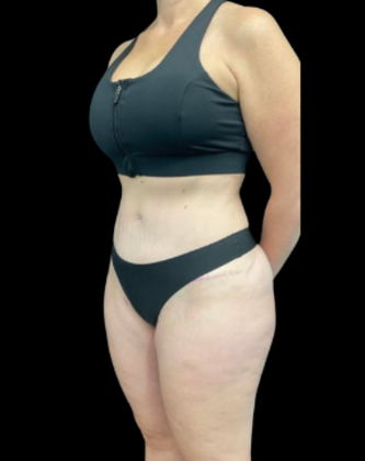 Brazilian Butt Lift: Case 21 - After