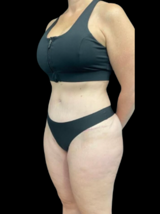 Brazilian Butt Lift: BBL 16 - After