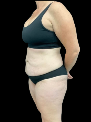 Brazilian Butt Lift: Case 21 - Before