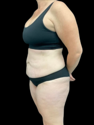 Brazilian Butt Lift: BBL 16 - Before