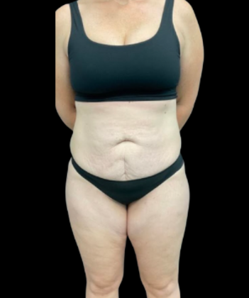 Brazilian Butt Lift: Case 21 - Before