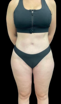 Brazilian Butt Lift: Case 21 - After