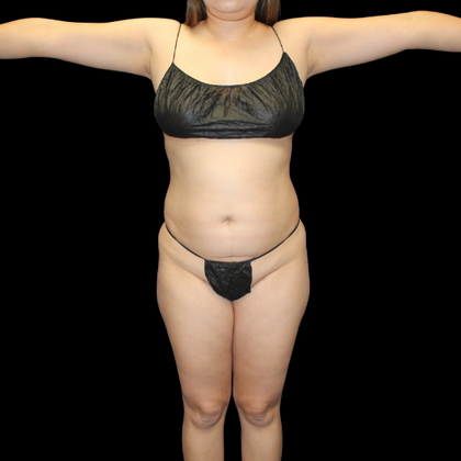 Liposuction Case 14 - Before