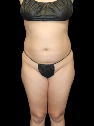 Liposuction Liposuction 3 - Before