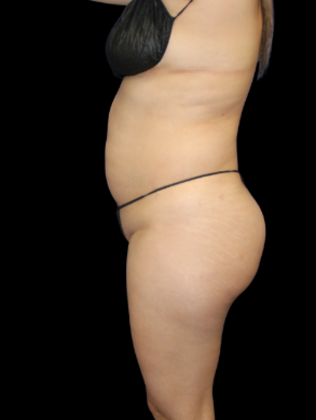 Liposuction: Liposuction 3 - Before