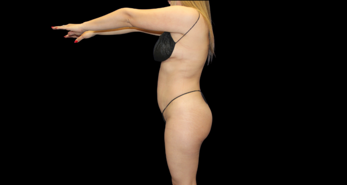 Liposuction: Case 14 - After