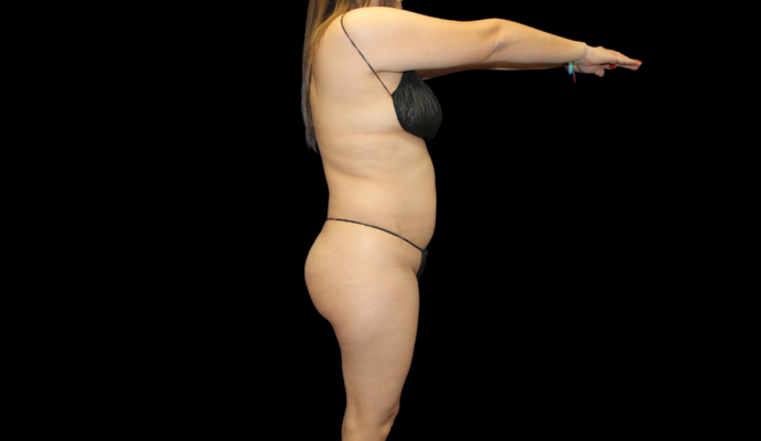 Liposuction: Case 14 - Before