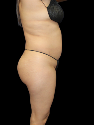 Liposuction: Liposuction 3 - Before