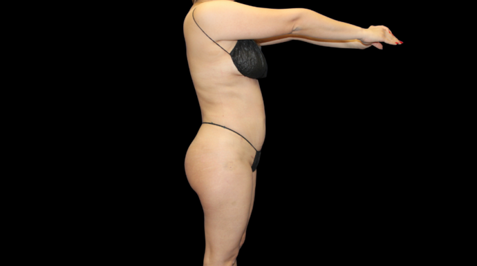 Liposuction: Case 14 - After