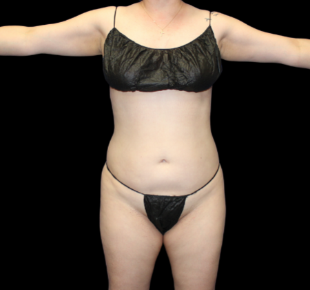 Brazilian Butt Lift: Case 22 - Before