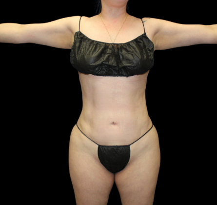 Brazilian Butt Lift: Case 22 - After