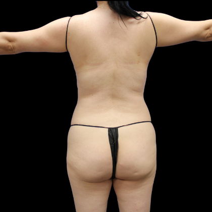 Brazilian Butt Lift Case 22 - Before