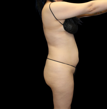 Brazilian Butt Lift: Case 22 - Before